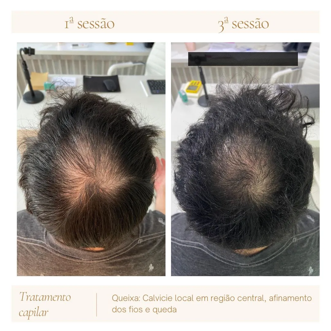 tratamento de calvice masculina